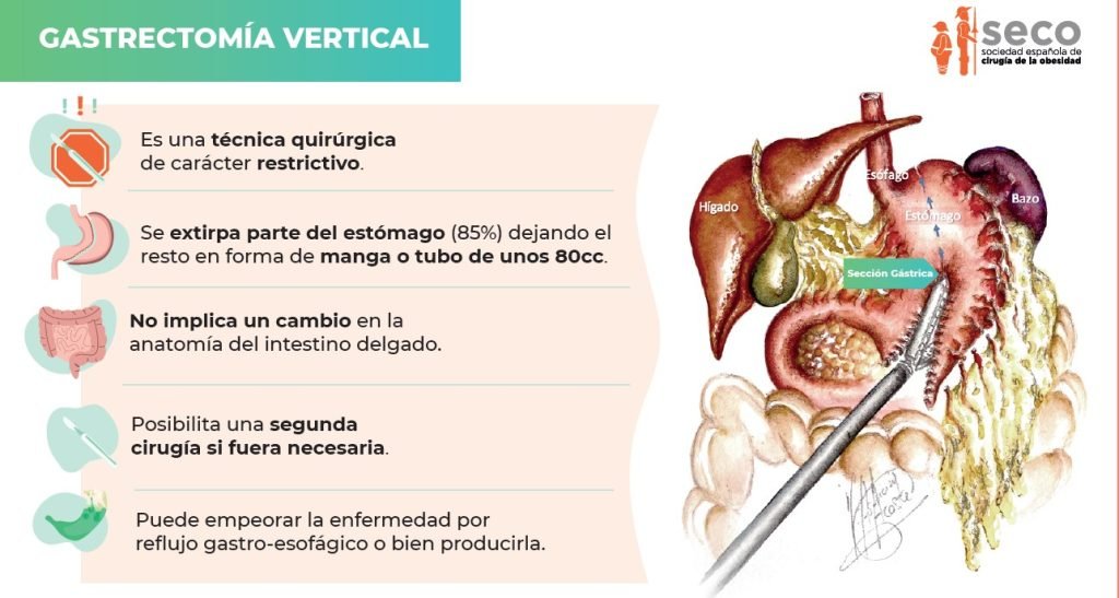 Todo lo que debes saber acerca de la cirugía de manga gástrica en Madrid